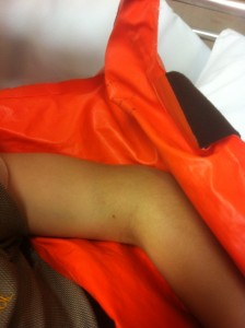 ililyo's broken elbow